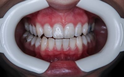 Dents saines