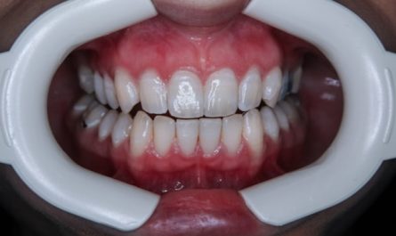 Dents saines