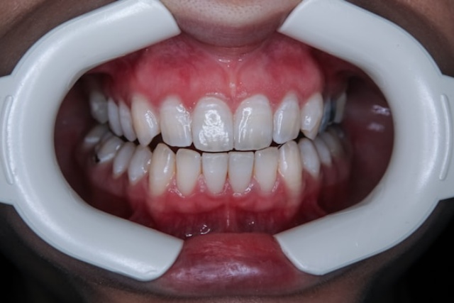 Dents saines