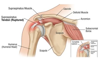 Rupture du tendon