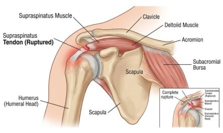 Rupture du tendon